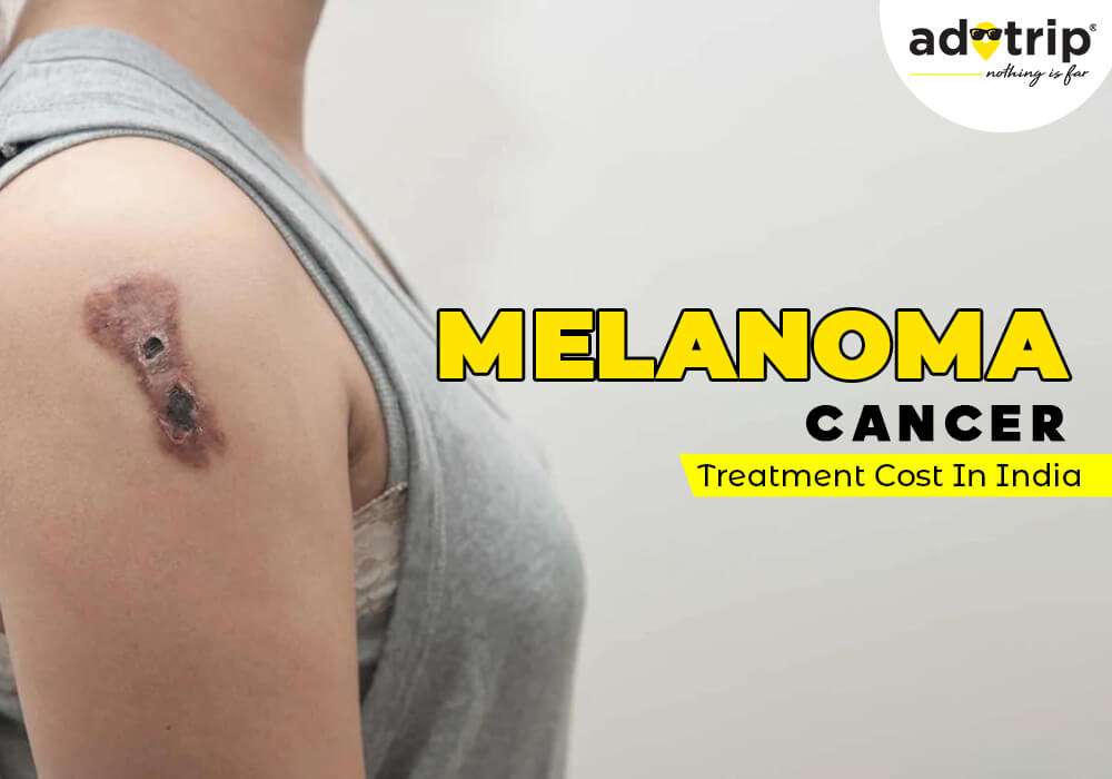 melanoma cancer treatment costs in India