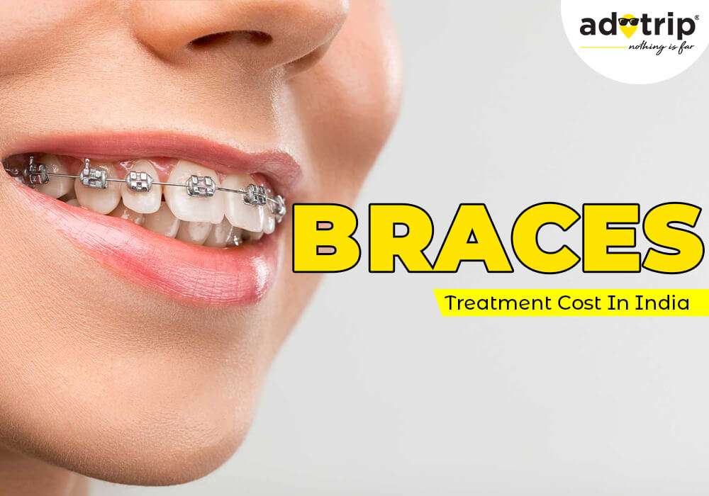 Braces treatment Cost In India Adotrip