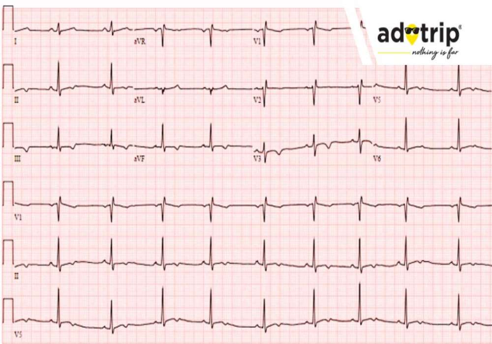 ecg cost in india, ecg test price in india
