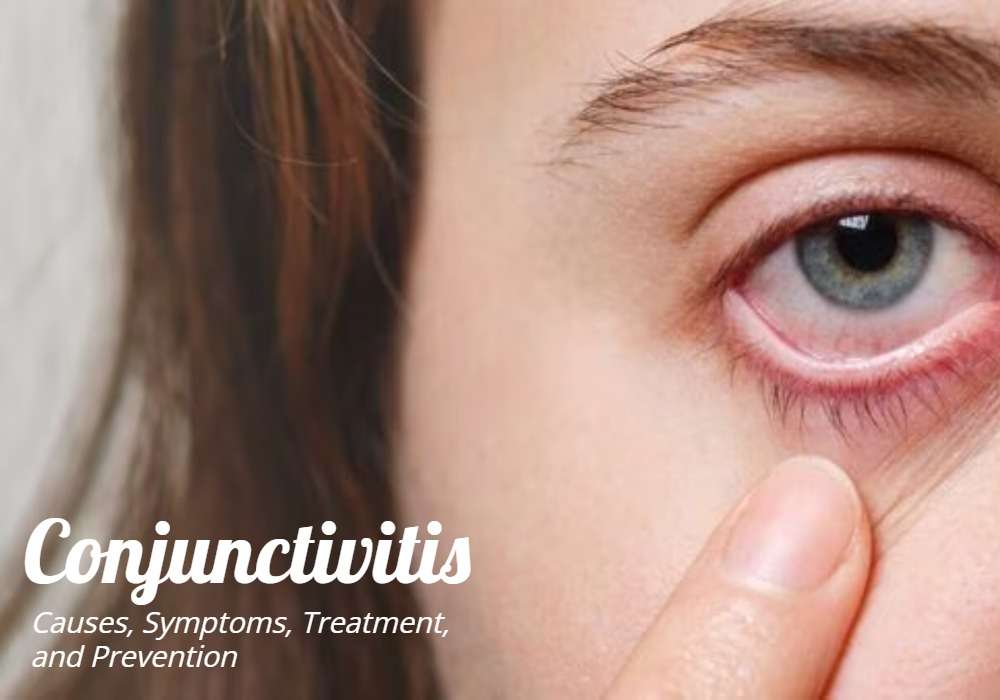 Conjunctivitis